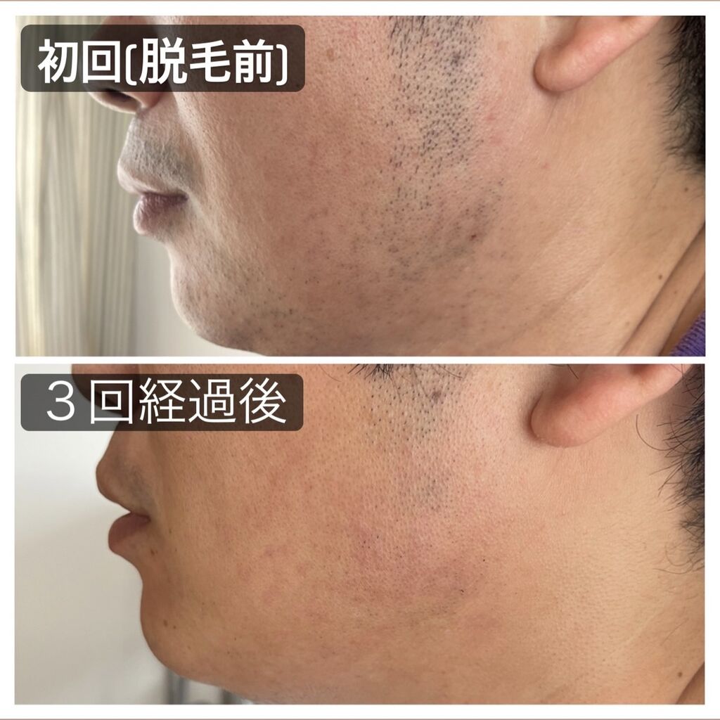 たっちんさんからメンズ脱毛サロンcrestへの投稿クチコミ 栃ナビ