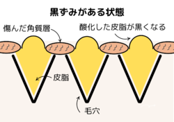 ”小鼻の黒ずみ” どうすればいい？ part.3　黒ずみからの卒業