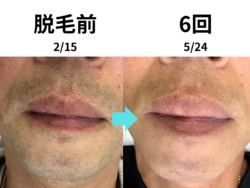 3ヶ月で青髭が見えなくなる！！
