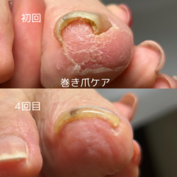 豊富な巻き爪ケア
