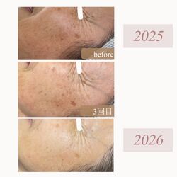 水光ピーリング