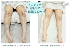 美容医療の術前後ケアもインディバで叶う!